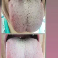تشخیص بیماری از روی عکس زبان