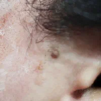 پلکسر وخال برداری ، مزونیدلینگ ، فشیال تخصصی|خدمات آرایشگری و زیبایی|مشهد, طلاب|دیوار