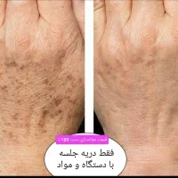 پاکسازی،فیشیال تخصصی،درمان مشکلات پوستی(تخفیف)|خدمات آرایشگری و زیبایی|گرگان, |دیوار