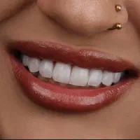 کامپوزیت لمینت روکش|خدمات زیبایی و سلامت|کرج, گوهردشت|دیوار