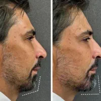 مرکز زیبایی بوتاکس و فیلر و تمامی خدمات زیبایی|خدمات آرایشگری و زیبایی|اصفهان, ملکشهر|دیوار