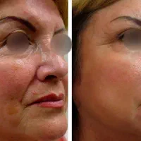 ژل بوتاکس آموزش تخصصی در مطب|خدمات آرایشگری و زیبایی|اصفهان, شهرک کاوه|دیوار