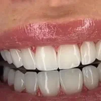 دندانپزشکی بدون پیش پرداخت اقساط ۲۴ ماهه|خدمات زیبایی و سلامت|قم, بکایی|دیوار