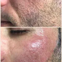 لیزر لک کک و مک و رفع تتو ولیزرموهای زاید