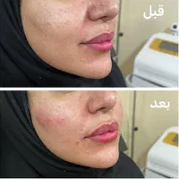 ژل لب فیلر بوتاکس لیزر مو هایفو پی آرپی خال برداری|خدمات آرایشگری و زیبایی|مشهد, آزادشهر|دیوار