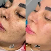ژل گیاهی جوانسازی ضدلک ضدجوش ضدکک مک