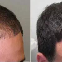 درمان قطعی ریزش مو و رویش مجدد|آرایشی، بهداشتی، درمانی|تهران, چیتگر شمالی|دیوار