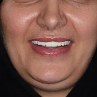 ایمپلنت زیبایی لمینت|خدمات آرایشگری و زیبایی|بازرگان, |دیوار