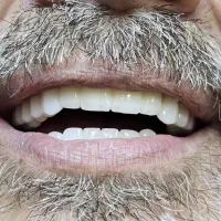 ایمپلنت کره ای ۶/۹۰۰ تخفیف بیشتربا دریافت کدتخفیف|خدمات آرایشگری و زیبایی|تهران, شهرآرا|دیوار