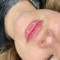 مطب پوست مو تزریق بوتاکس فیلر مزوتراپی هایفو