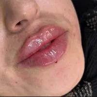 اف تزریق ژل روسی،عربی،خلیجی، بوتاکس|خدمات آرایشگری و زیبایی|شیراز, شهرک امیر کبیر|دیوار