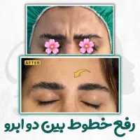 تزریق تخصصی بوتاکس صورت توسط پزشک، مطب زیبایی رشت