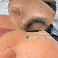 پوست کره ای (مزو وایت)