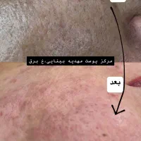 فیشال تخصصی و درمانی با برند کلینیکی کره جنوبی|خدمات آرایشگری و زیبایی|بندر کنگان, |دیوار