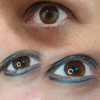 ریـموو تخصصی تتو صورت