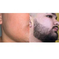درماژن