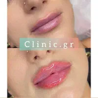 ژل لب و چانه و بوتاکس و نخ و لیزر و لیزر موهای بدن|خدمات آرایشگری و زیبایی|تهران, آذربایجان|دیوار