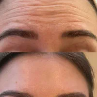 لیزر،بوتاکس، مزوتراپی، فیلر،وایتینگ|خدمات آرایشگری و زیبایی|هشترود, |دیوار