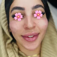 فیلر لب.بوتاکس.مزوژل.لب روسی.|خدمات آرایشگری و زیبایی|بندر انزلی, چهارفریضه|دیوار