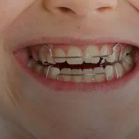 ارتودنسی کودکان رایگان