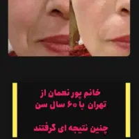 کرم چین و چروک|آرایشی، بهداشتی، درمانی|آباده, |دیوار