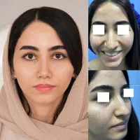 جراحی بینی پیزوسرجری،ویژه جشنواره