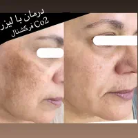 لیزر موهای زائد الکس پلاس (شاتی) بدون ژل/درمان لک|خدمات آرایشگری و زیبایی|رشت, گلسار|دیوار