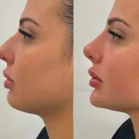 ژل و بوتاکس/ ژل لب/کانتورینگ عربی/روسی|خدمات آرایشگری و زیبایی|فردیس, فردیس|دیوار