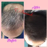 بوتاکس،ژل،چربی،ساکشن غبغب،آموزش سابسیژن پی ارپی|خدمات آرایشگری و زیبایی|اصفهان, شاهزید|دیوار