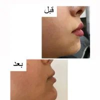 خدمات ژل بوتاکس آنزیم فیلر جوانساز مرو سر ابرو|خدمات آرایشگری و زیبایی|چهارباغ, |دیوار