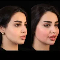 تزریق ژل و بوتاکس با تخفیف بهاره