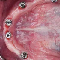 ایمپلنت با اقساط بلند مدت در تبریز