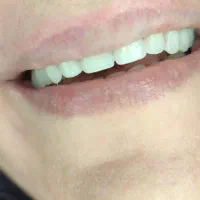 دندان مصنوعی لمینتی طرح لبخند|خدمات آرایشگری و زیبایی|محمدیه-قزوین, |دیوار