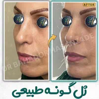 فیلر(ژل) لب گونه چانه خط خنده زاویه توسط پزشک رشت|خدمات آرایشگری و زیبایی|رشت, گلسار|دیوار
