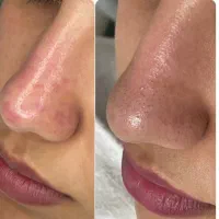 جشنواره فیشال وپاکسازی پوست خانمها واقایان|خدمات آرایشگری و زیبایی|همدان, |دیوار