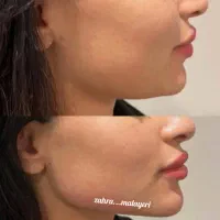 تزریق ژل فیلر تضمینی بوتاکس پرسینگ چاله گونه