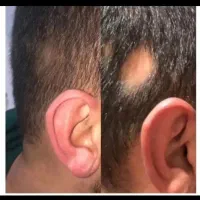 بدون کاشت و با کمترین هزینه و در کمترین زمان