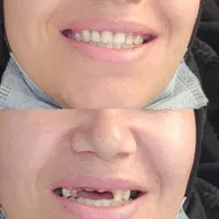 دندان دندانسازی پروتز با چک|خدمات آرایشگری و زیبایی|مشهد, موعود|دیوار