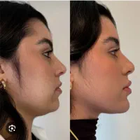 مدل کانتورینگ صورت