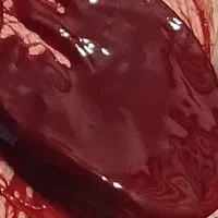 حجامت وبادکش زالو شکسته بند ودررفتگی کل بدن سیاتیک