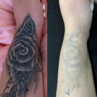 ریموو تتو های قدیمی بدن با دستگاه لیزر کیوسوییچ