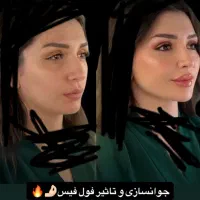 تخفیفات جمعه سیاه با بوتاکس رایگان توسط پزشک|خدمات آرایشگری و زیبایی|قم, هفت تیر|دیوار