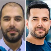 کاشت مو ، ابرو و ریش