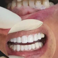 کامپوزیت دندان