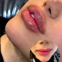 تزریق ژل و بوتاکس و انزیم و مزوجوانساز.