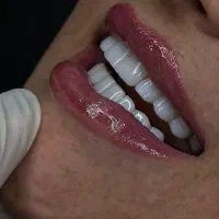 هلی کلینیک هر واحد کامپوزیت 800هزارتومان|خدمات آرایشگری و زیبایی|ایلام, |دیوار