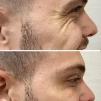 بوتاکس کل صورت ( پیشانی ، زیربغل ، کف دست و پا )|خدمات زیبایی و سلامت|اصفهان, خانه اصفهان|دیوار