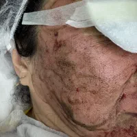 تخلیه لک و مشکلات پوستی اولین بار در استان
