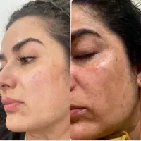 تخفیف 50% لیزری،سفید کردن صورت بیکینی(ایرانا)