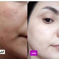 کرم vip بزرگ ضدلک و سفید کننده|آرایشی، بهداشتی، درمانی|گرگان, |دیوار